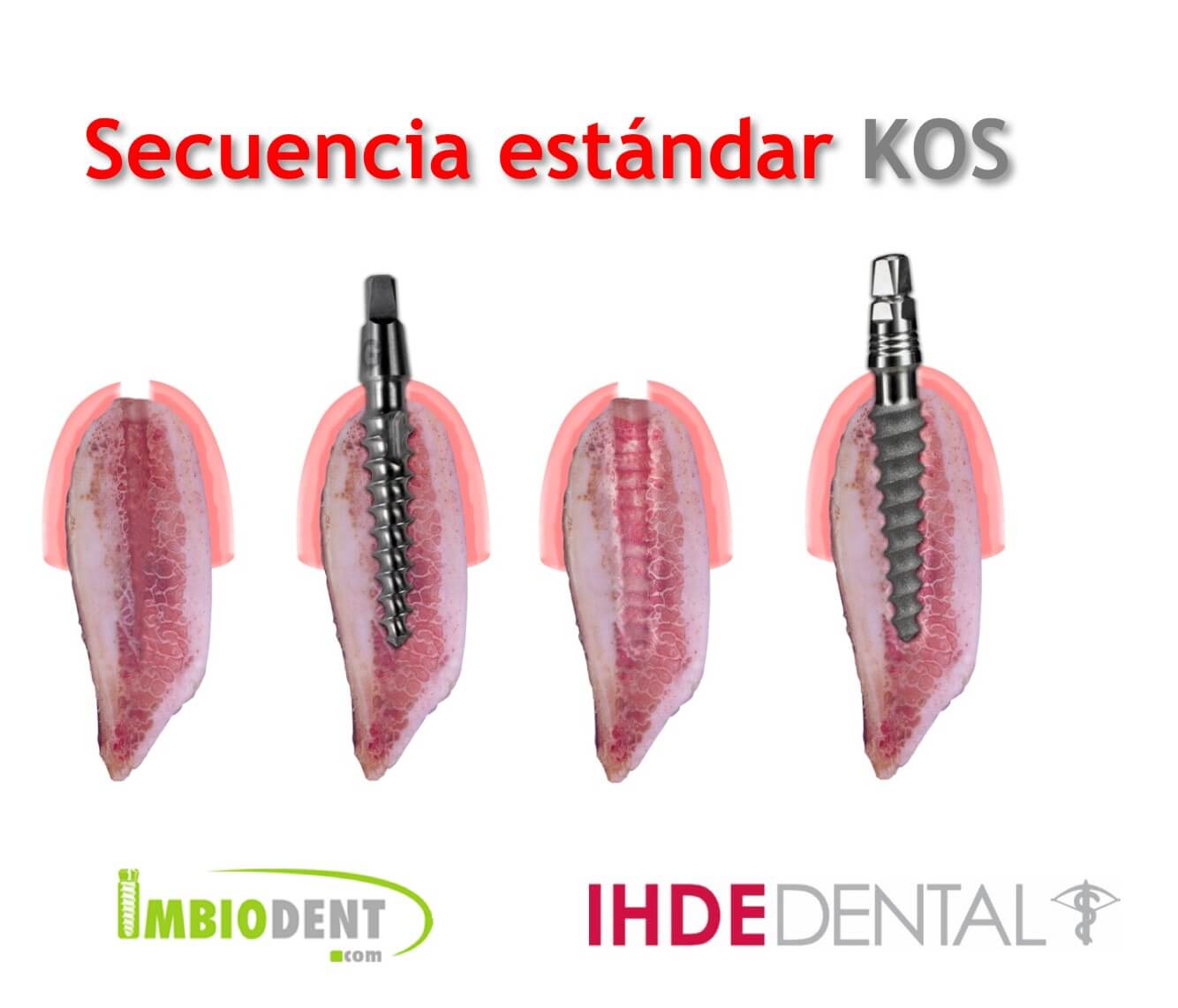 Implantologia Basal Imbiodent Profesionales En Implantologia Dental